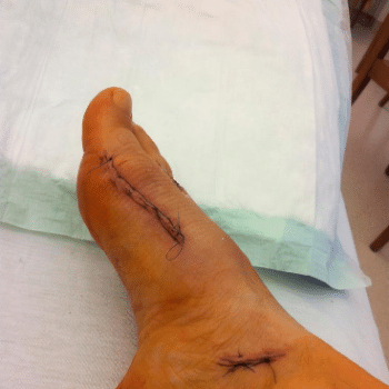 Chodidlo po operácii vybočenéh palca Hallux Valgus